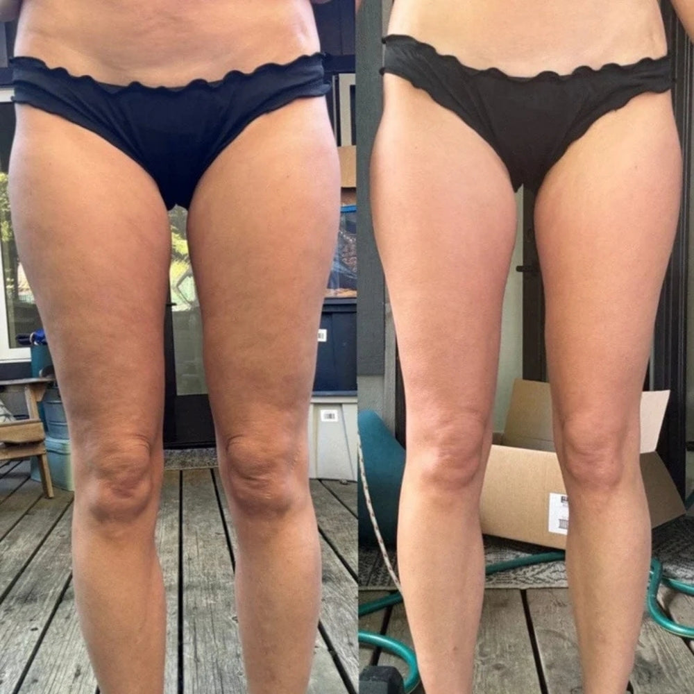 Cozzuri™ - Anti-Cellulite Massager